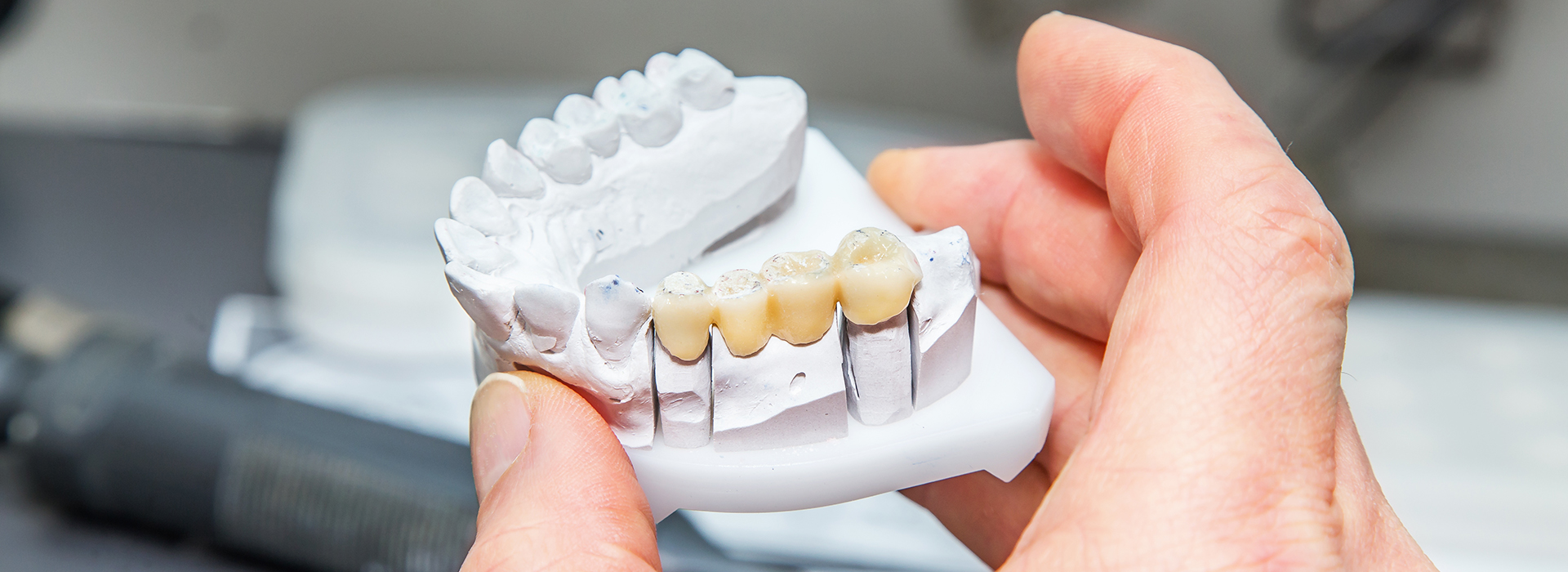 The image shows a person holding a dental implant with a screw visible on top, using a tool to manipulate it.
