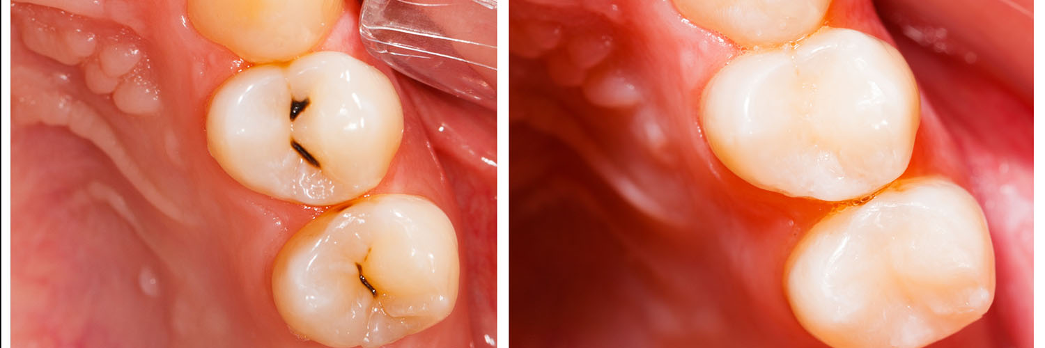 The image shows a close-up view of a person s mouth with a dental implant and a partially visible toothbrush, set against a plain background.