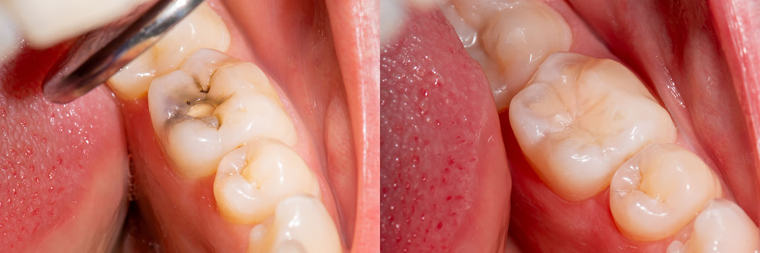 The image shows a close-up view of a dental mouth with multiple teeth missing, revealing the gums and bone structure, with a focus on the lower front area where there are visible signs of decay or infection, and a small object that appears to be a dental tool or implant in the process of being inserted or removed.