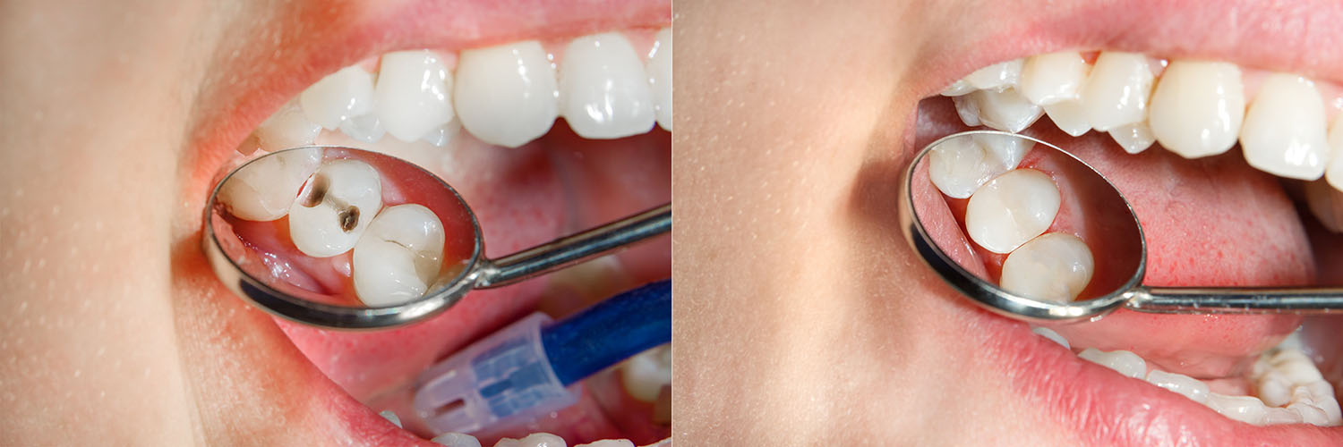 The image shows a person s mouth with teeth, holding a magnifying glass over their tongue, which has a blue object on it.