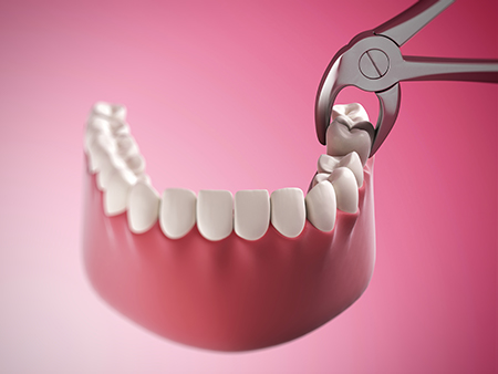 The image shows a close-up of a dental implant being placed into a pink gum with teeth on either side, using a pair of pliers held by a hand visible from the wrist down, indicating a surgical procedure in progress.