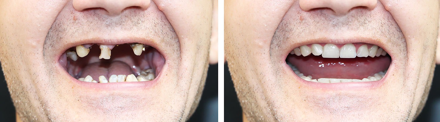 The image shows a person with two different teeth arrangements  one side has a full set of teeth while the other appears to be missing several teeth, with a humorous effect created by digitally manipulating the photo.
