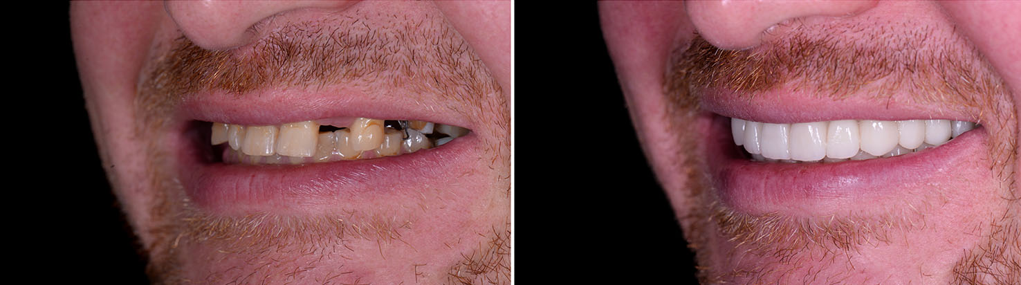 The image shows a person with two different smiles on either side of their face, displayed side by side.