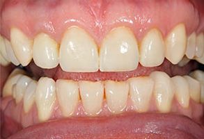 The image shows a close-up view of a person s teeth with signs of dental decay and discoloration, likely from a tooth whitening advertisement.