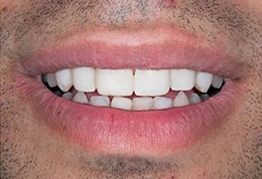 The image displays a close-up of a person s smiling mouth with teeth showing, against a neutral background.