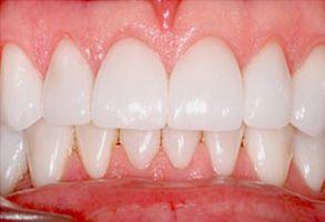 The image shows a close-up view of a human mouth with teeth that appear to be undergoing cosmetic dental treatment, possibly involving veneers or orthodontic work, as indicated by the visible preparation and bonding material on the front teeth.