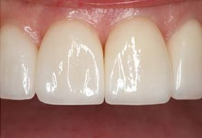 The image shows a close-up view of a person s teeth with a focus on a dental procedure, specifically a smile makeover, featuring a bright white smile with clean teeth and a glossy finish.