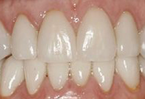 The image displays a close-up view of a person s teeth with a focus on a large gap between two front teeth, showcasing a dental condition known as diastema.
