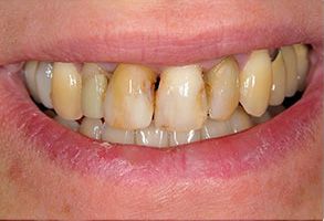A person s mouth with yellowed teeth and gums showing signs of poor oral health.