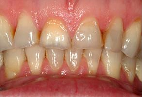 The image shows two views of an open mouth with severe tooth decay, displaying yellowed teeth and gum disease, which are indicative of poor oral hygiene.