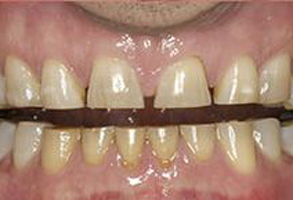 An image featuring a person s mouth with crooked yellowish teeth and a partial metal wire across the front teeth, displayed against a plain background.